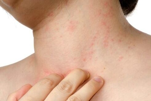 alergija poodiniams parazitams
